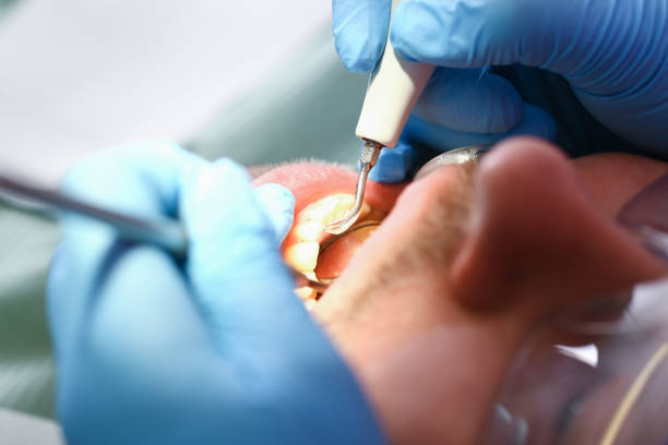 Best Emergency Dental Care for Broken or Chipped Teeth in Westlake, OH